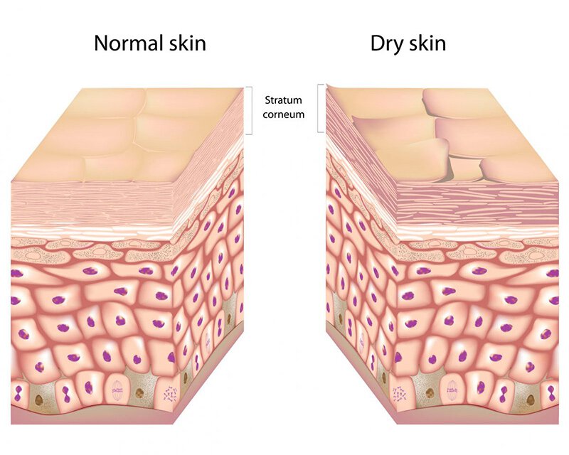 normal and dry skin comparison illustration