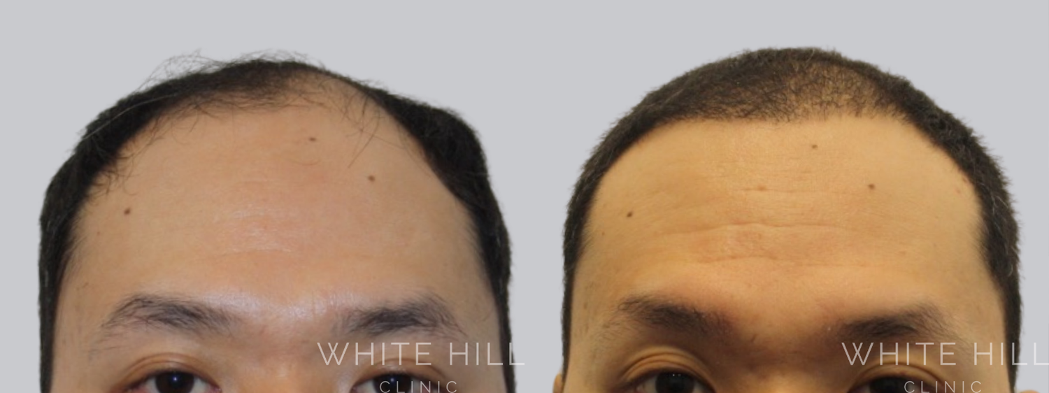 Hair Transplant Surgery Sydney - White Hill Clinic