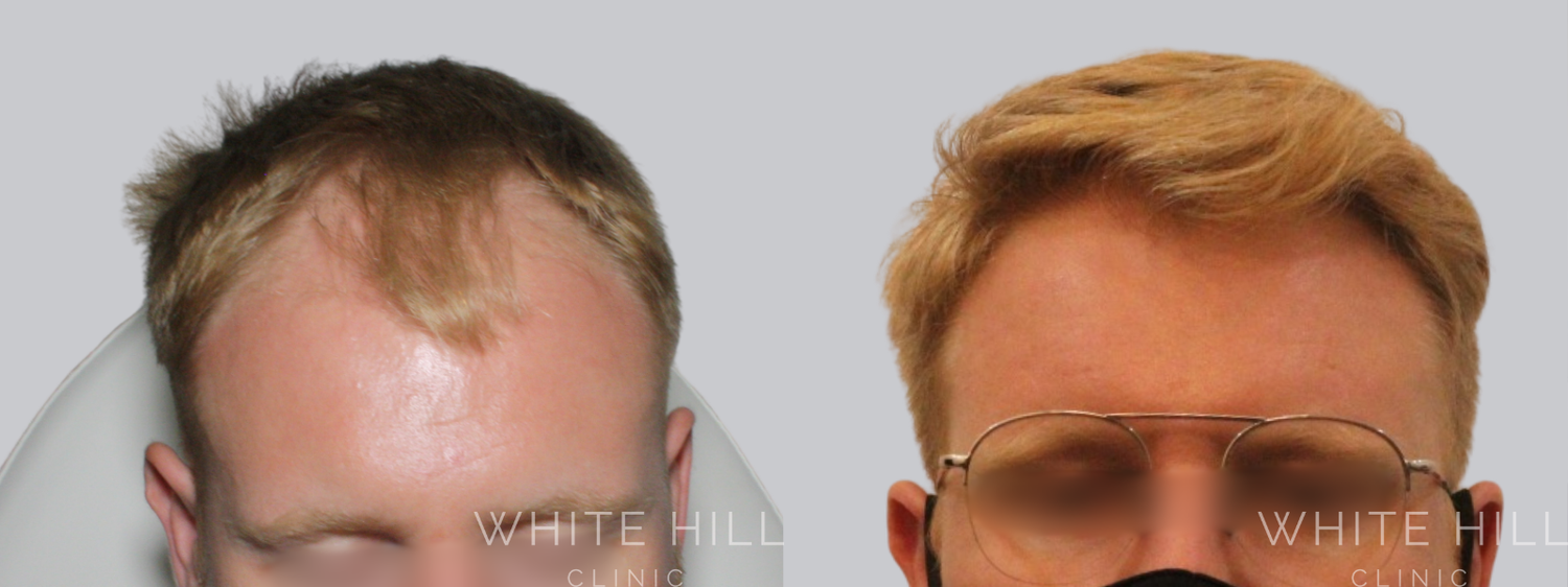 Hair Transplant Surgery Sydney - White Hill Clinic