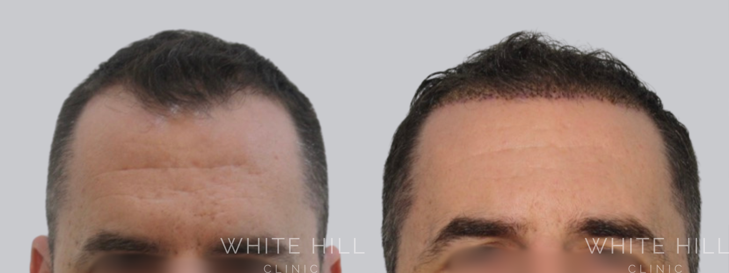 Hair Transplant Surgery Sydney - White Hill Clinic