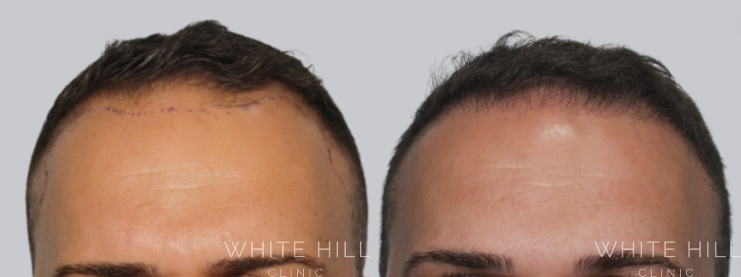 Hair Transplant Surgery Sydney - White Hill Clinic