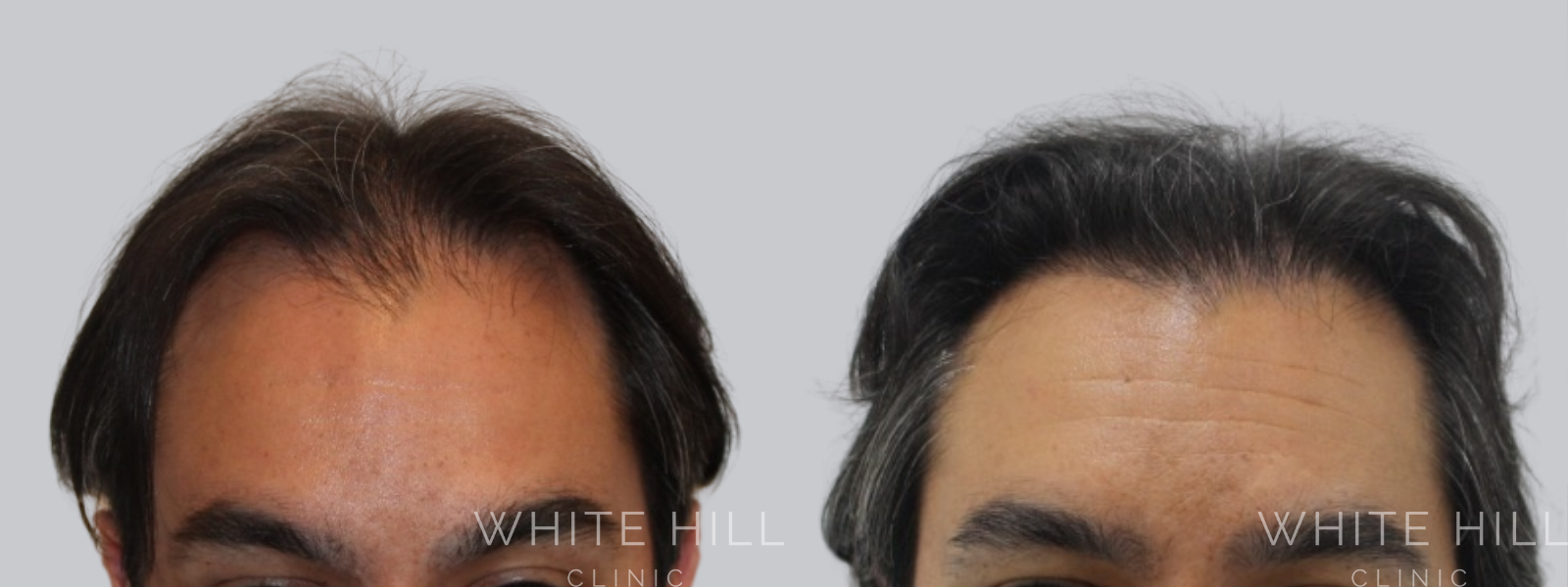 Hair Transplant Surgery Sydney - White Hill Clinic