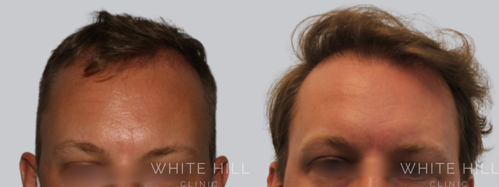 Hair Transplant Surgery Sydney - White Hill Clinic