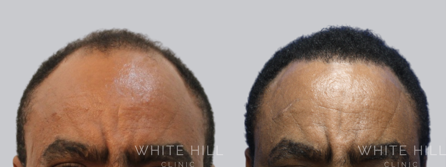 Hair Transplant Surgery Sydney - White Hill Clinic