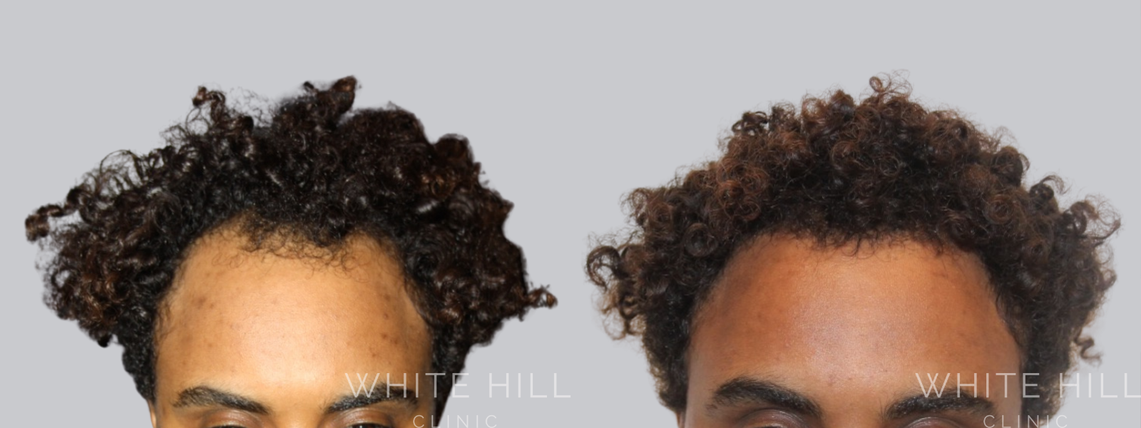 Hair Transplant Sydney - White Hill Clinic