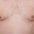 3 things you should know about treatment for ‘man boobs’