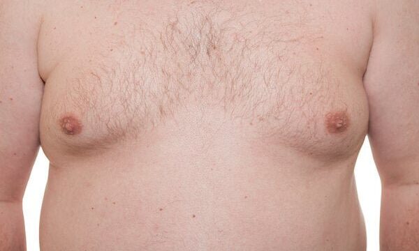 3 things you should know about treatment for ‘man boobs’