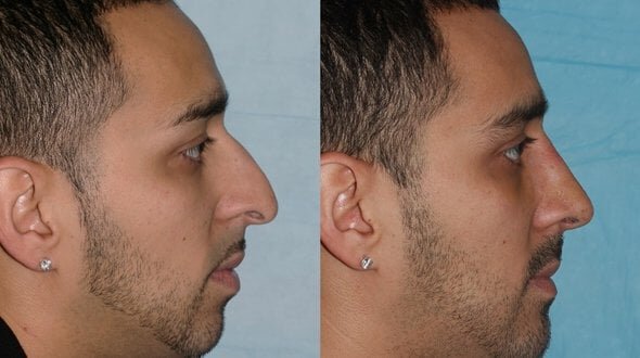 Cosmetic Surgery for Australian Men