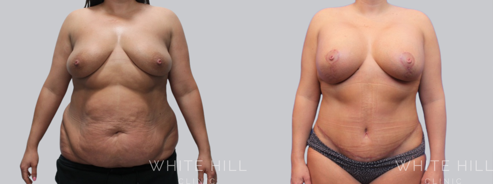 Abdominoplasty Sydney - White Hill Clinic