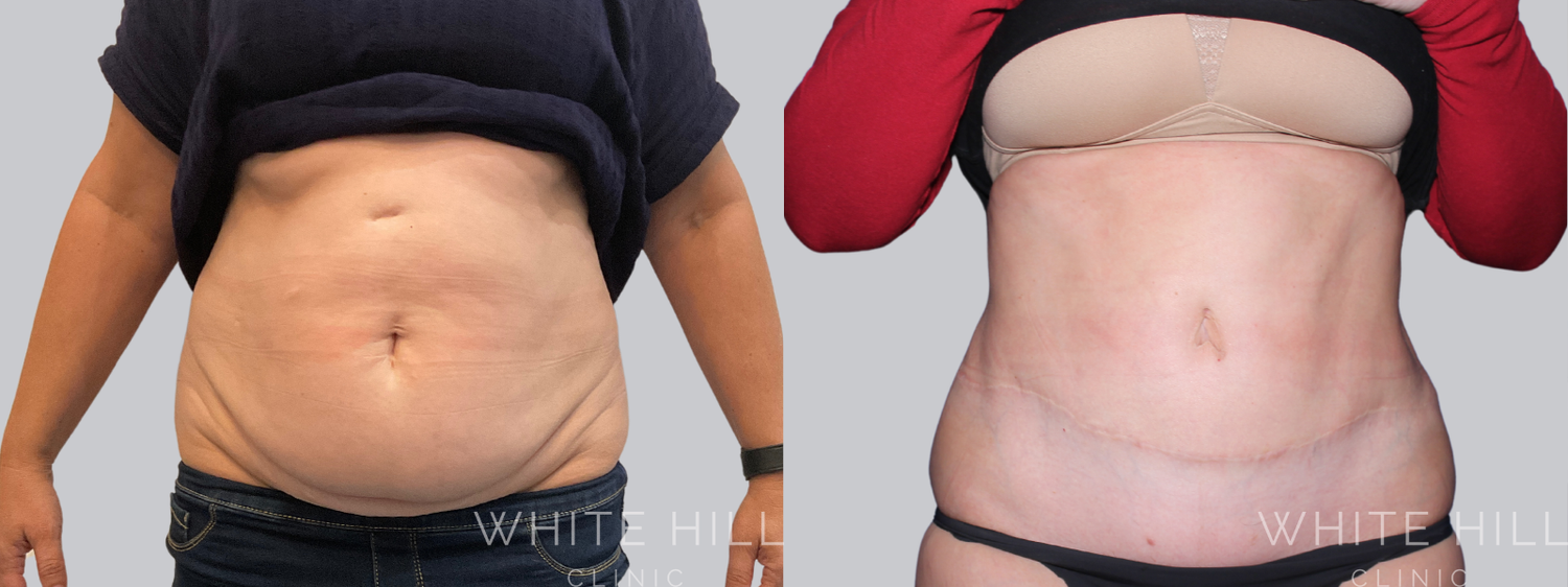 Abdominoplasty Sydney White Hill Clinic