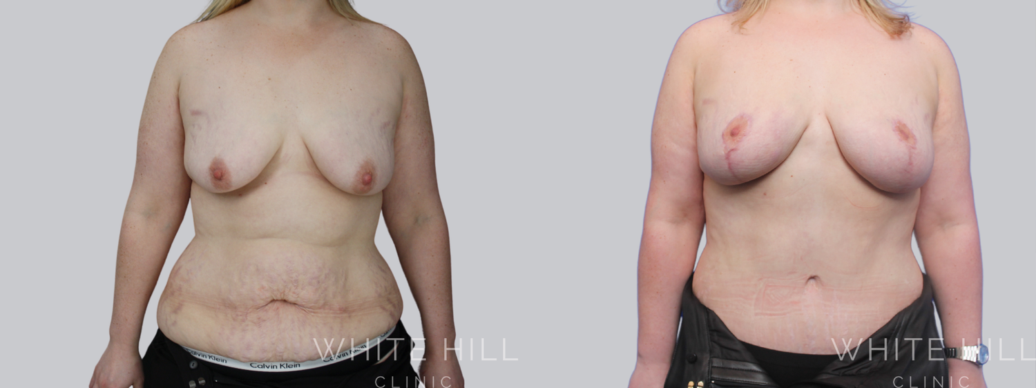 Abdominoplasty Sydney White Hill Clinic