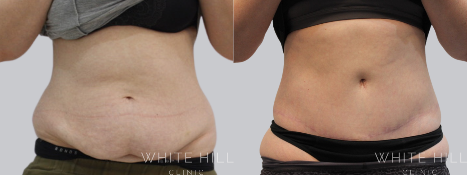 Abdominoplasty Sydney - White Hill Clinic