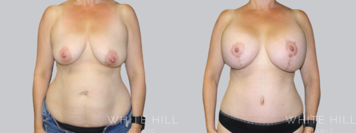 Abdominoplasty Sydney - White Hill Clinic