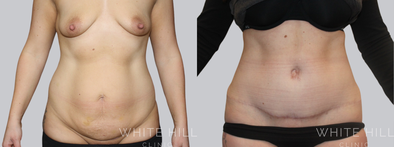 Abdominoplasty Sydney - White Hill Clinic