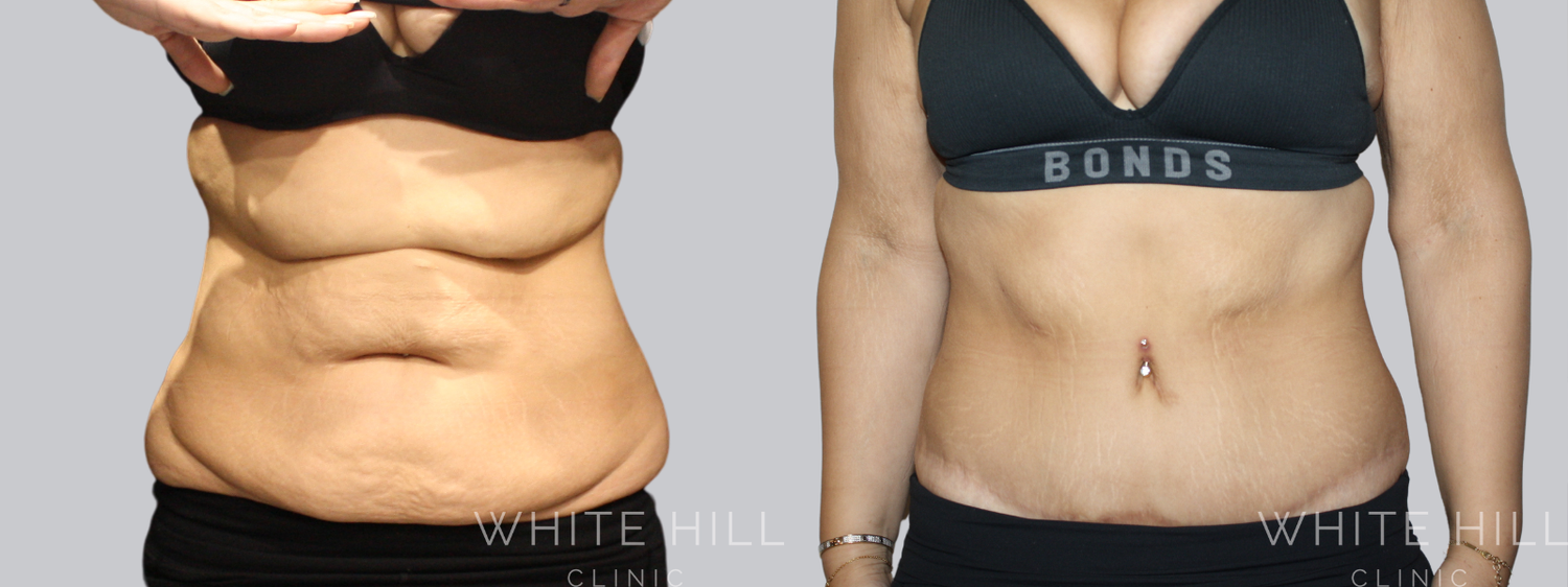 Abdominoplasty Sydney - White Hill Clinic