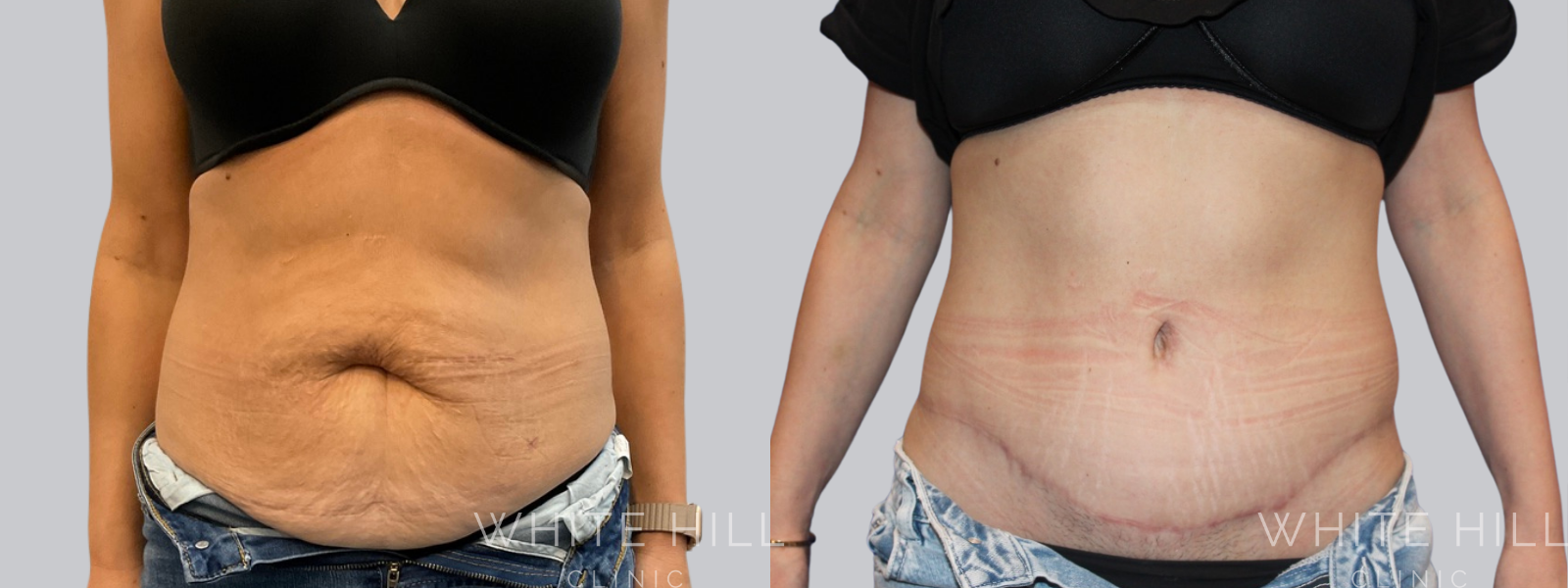 Abdominoplasty Sydney - White Hill Clinic