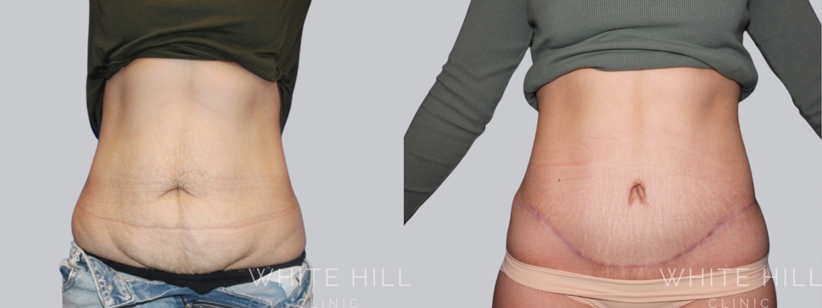 Abdominoplasty Sydney - White Hill Clinic