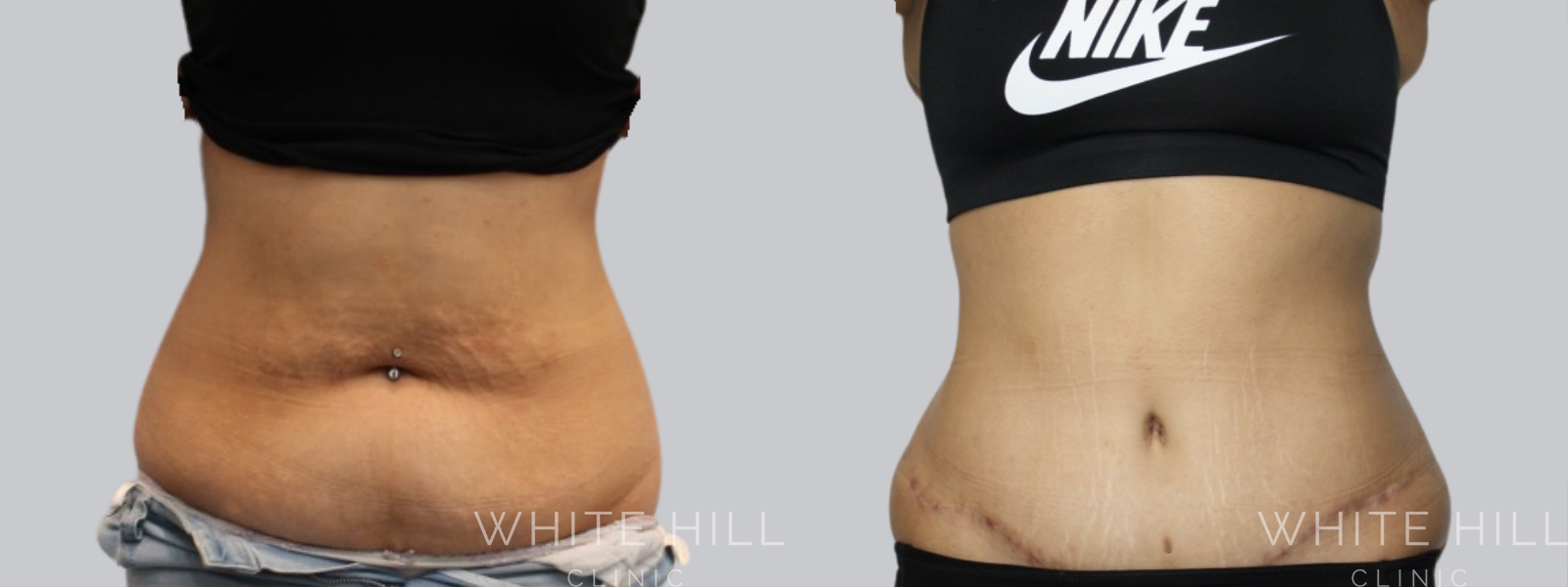 Abdominoplasty Sydney White Hill Clinic