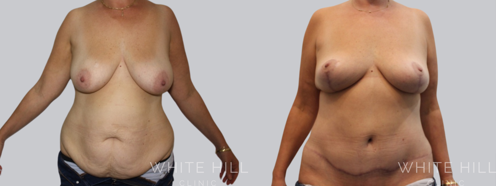 Abdominoplasty Sydney White Hill Clinic