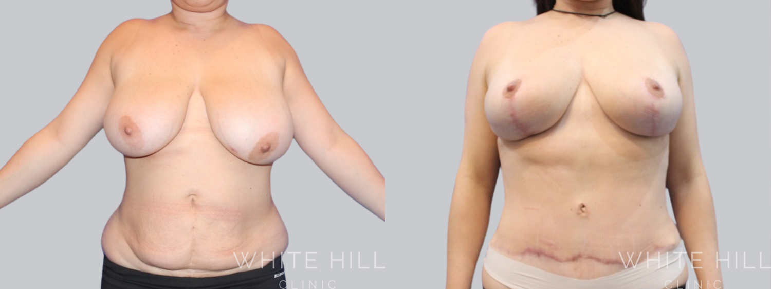 Abdominoplasty Sydney - White Hill Clinic