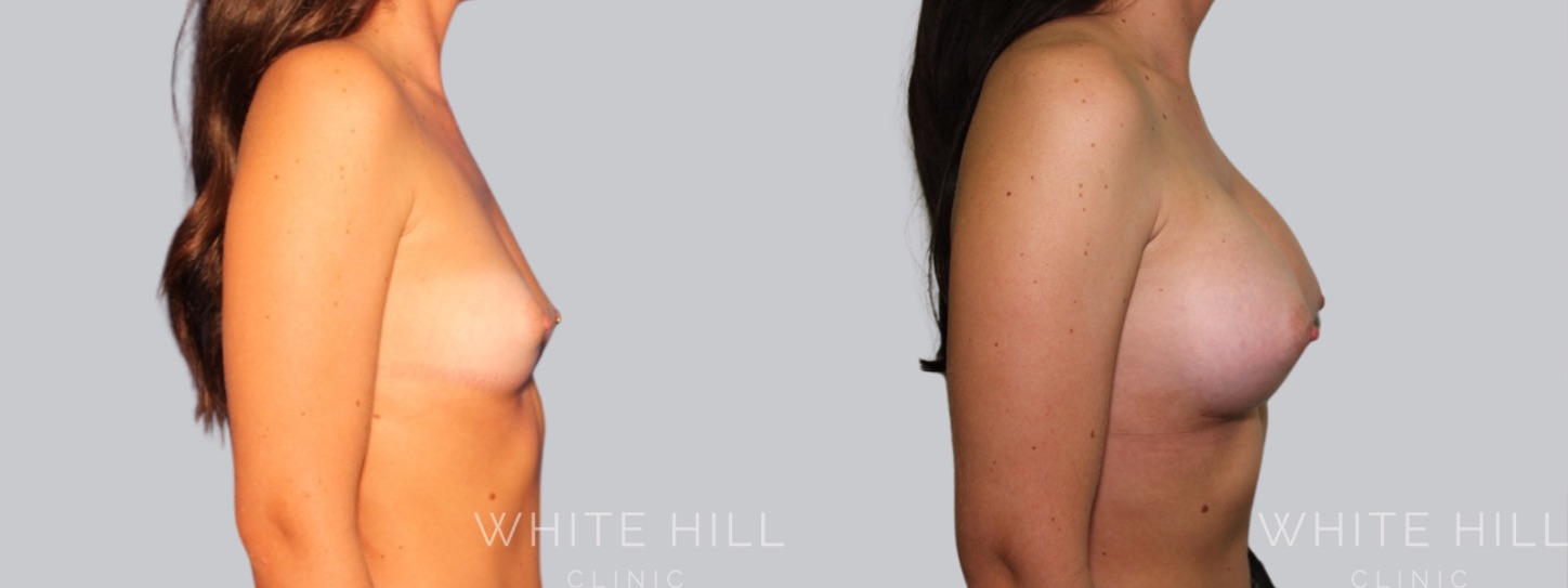 Breast Augmentation Surgery Sydney White Hill Clinic