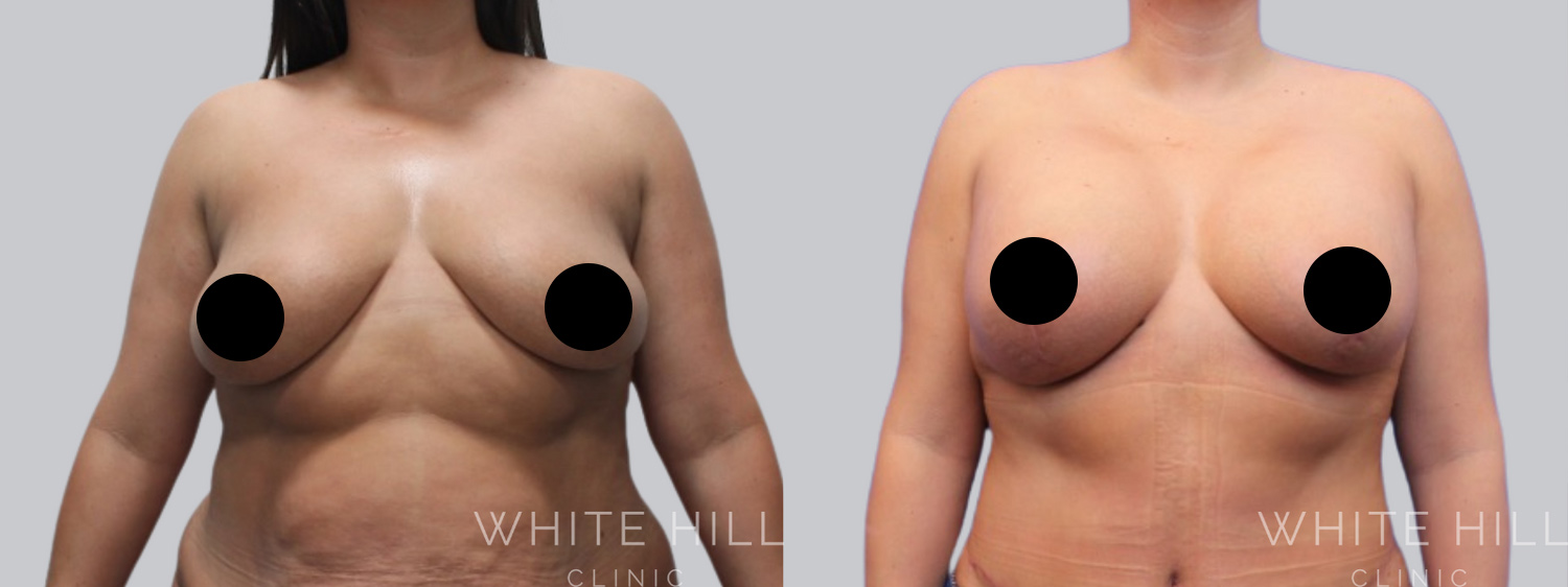 Breast Augmentation and Lift Before and After Surgery Sydney