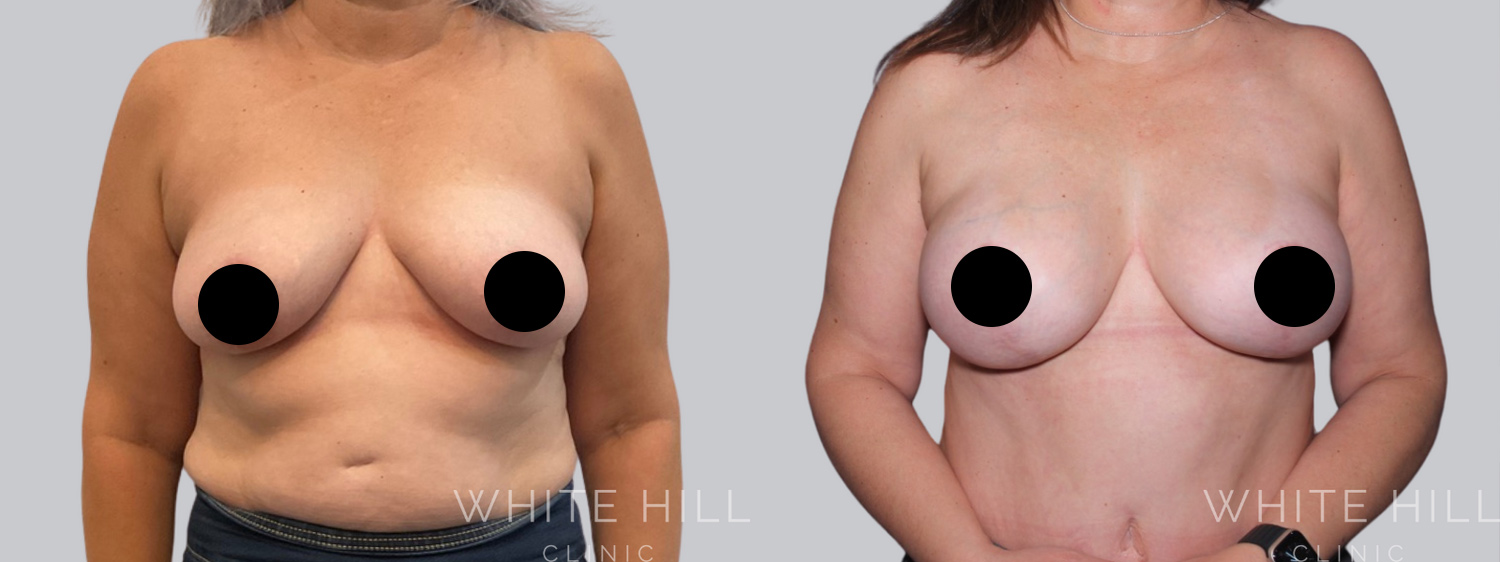 Breast Lift & Augmentation Before and After