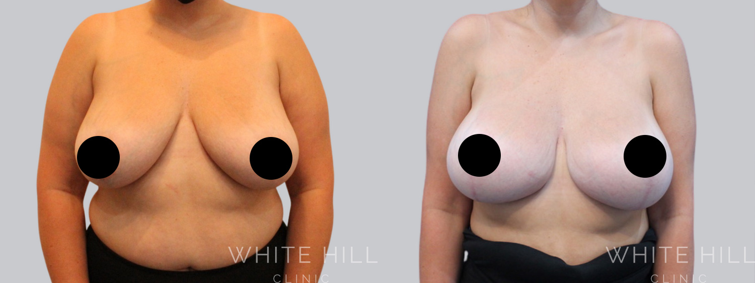 Breast Lift & Augmentation Before and After