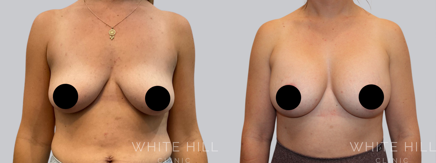 Breast Lift & Augmentation Before and After