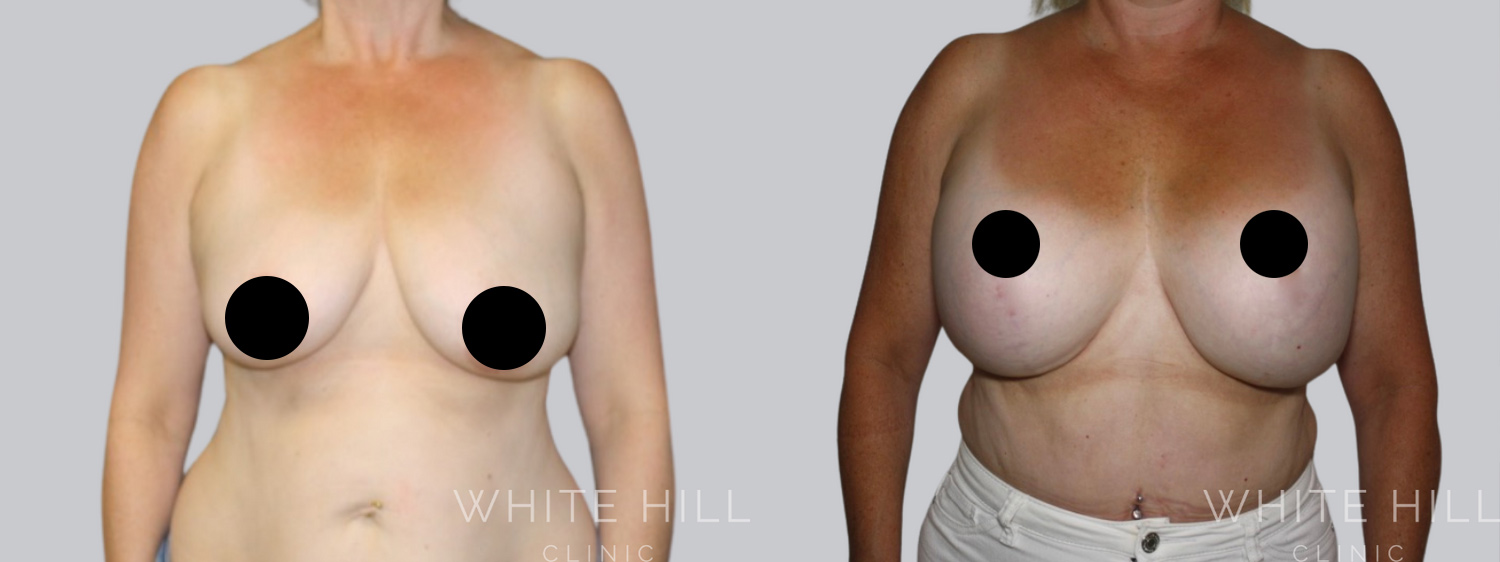 Breast Lift & Augmentation Before and After