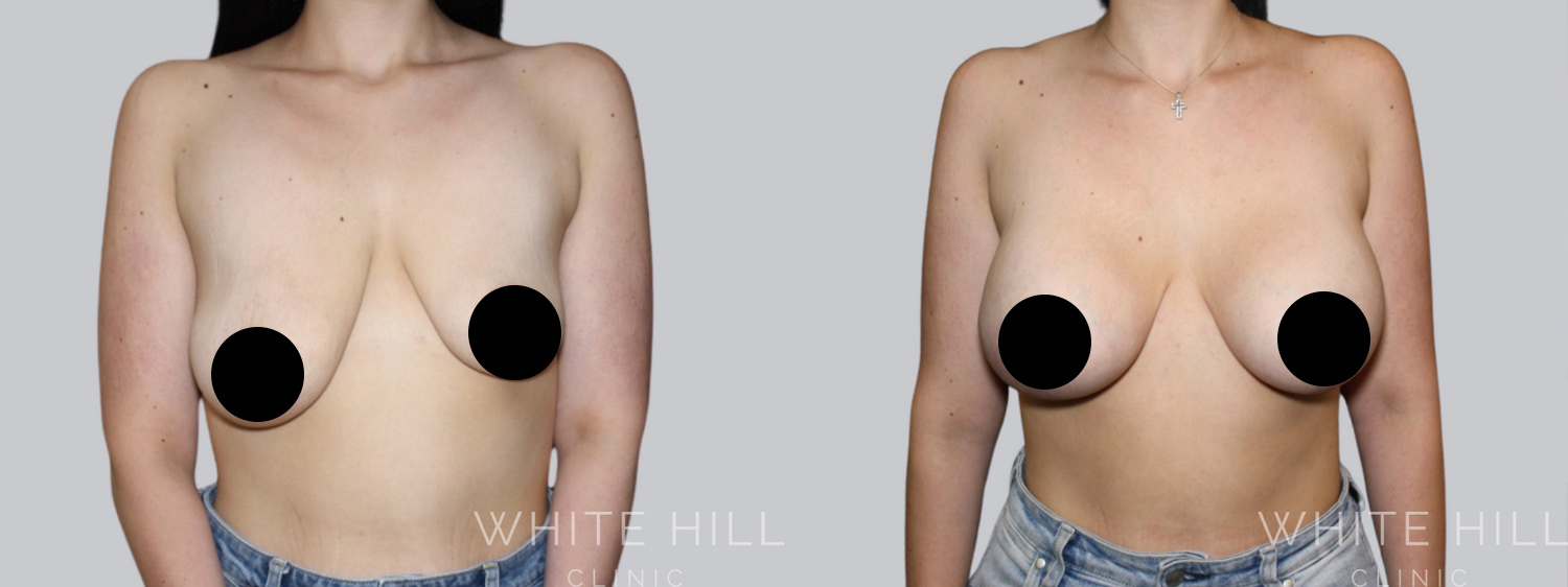 Breast Augmentation and Lift Before and After Surgery Sydney