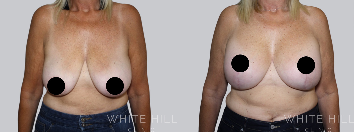 Breast Augmentation and Lift Before and After Surgery Sydney