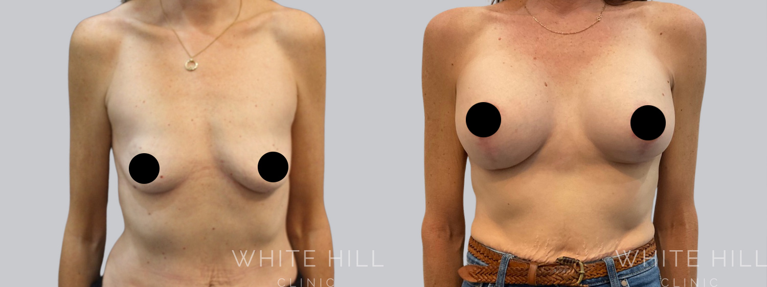 Breast Augmentation and Lift Before and After Surgery Sydney