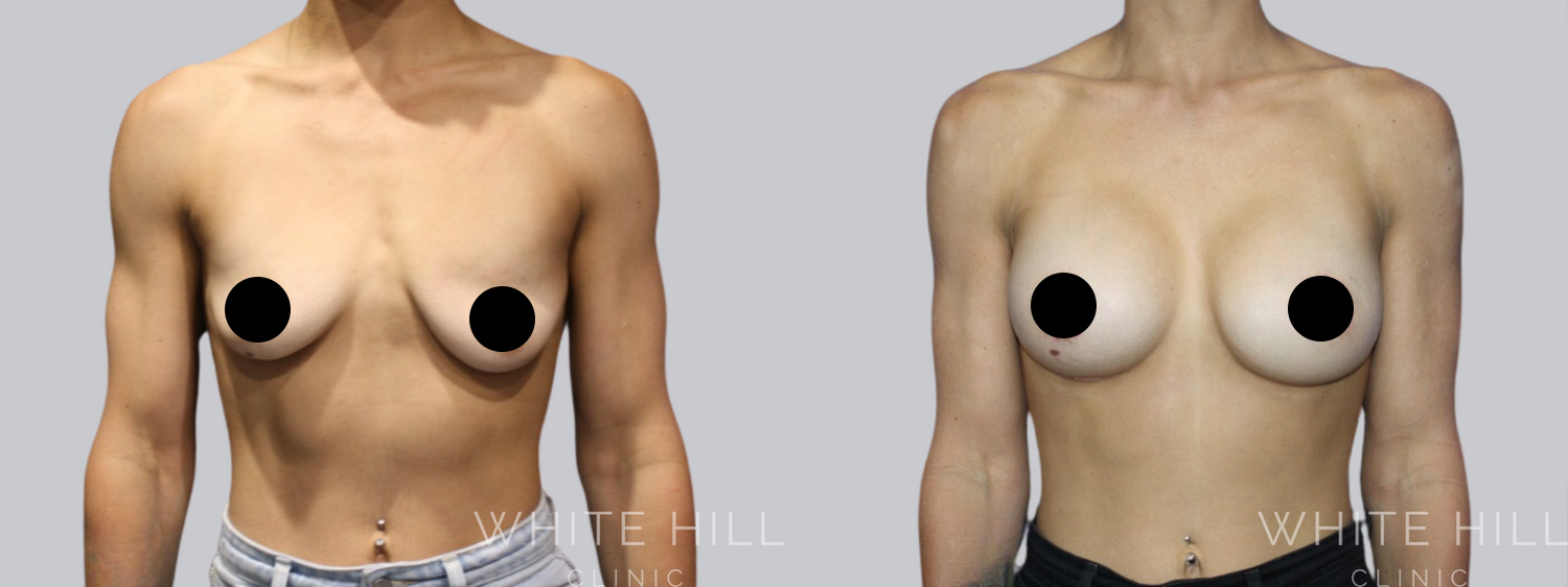 Breast Augmentation and Lift Before and After Surgery Sydney