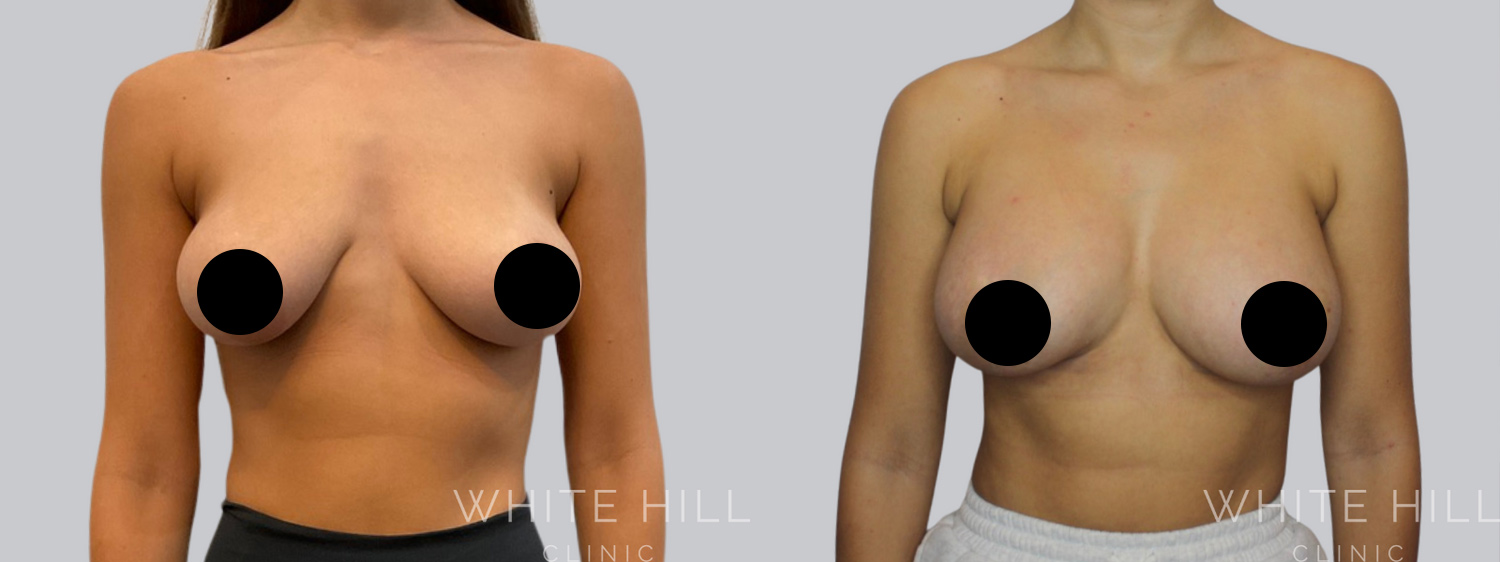 Breast Augmentation and Lift Before and After Surgery Sydney