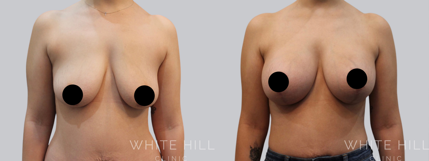 Breast Lift & Augmentation Before and After