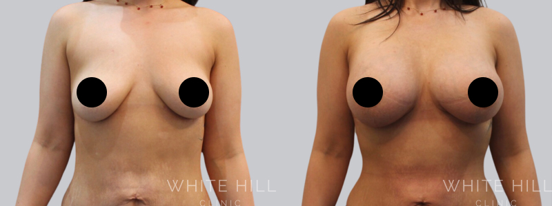 Breast Augmentation before after