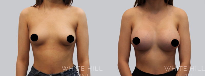 Breast Augmentation before after