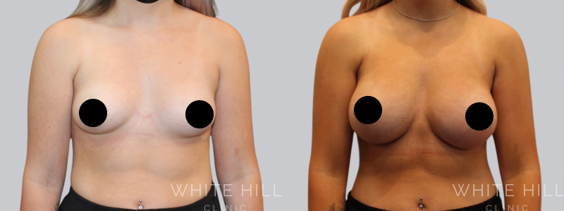 Breast Augmentation before after