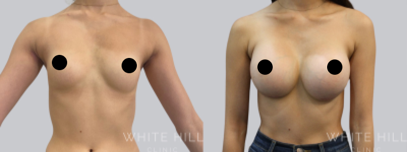 Breast Augmentation before after