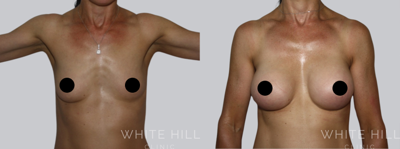 Breast Augmentation before after