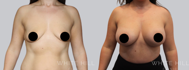 Breast Augmentation before after