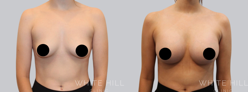 Breast Augmentation before after