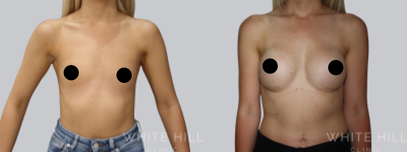 Breast Augmentation before after