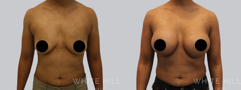 Breast Augmentation before after