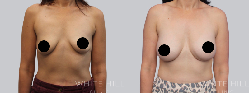 Breast Augmentation before after