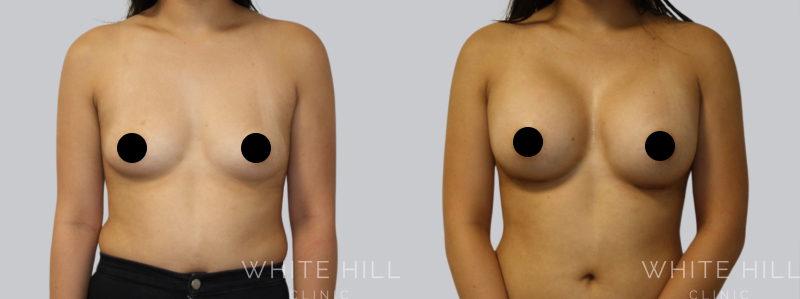 Breast Augmentation before after