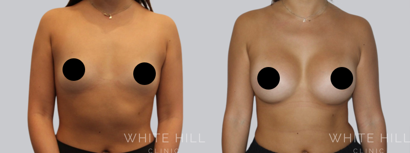 Breast Augmentation before after