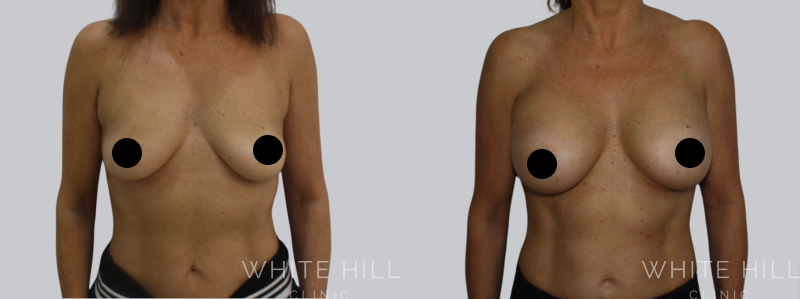 Breast Augmentation before after