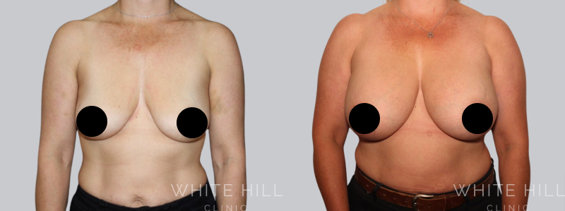 Breast Augmentation before after